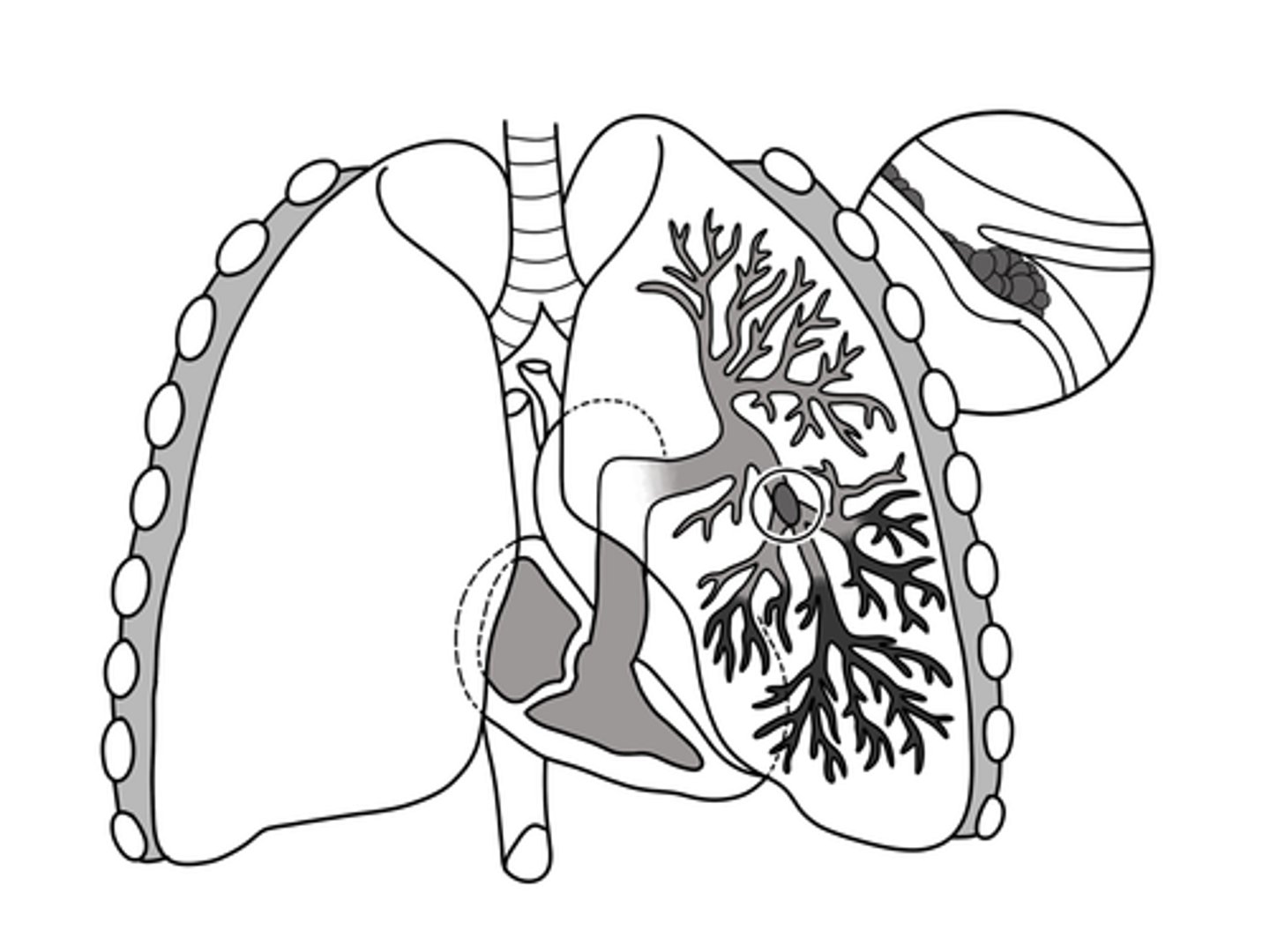 <p>A portion of a thrombus that breaks free and travels through the bloodstream, causing blockage and restricting blood flow to an organ.</p>