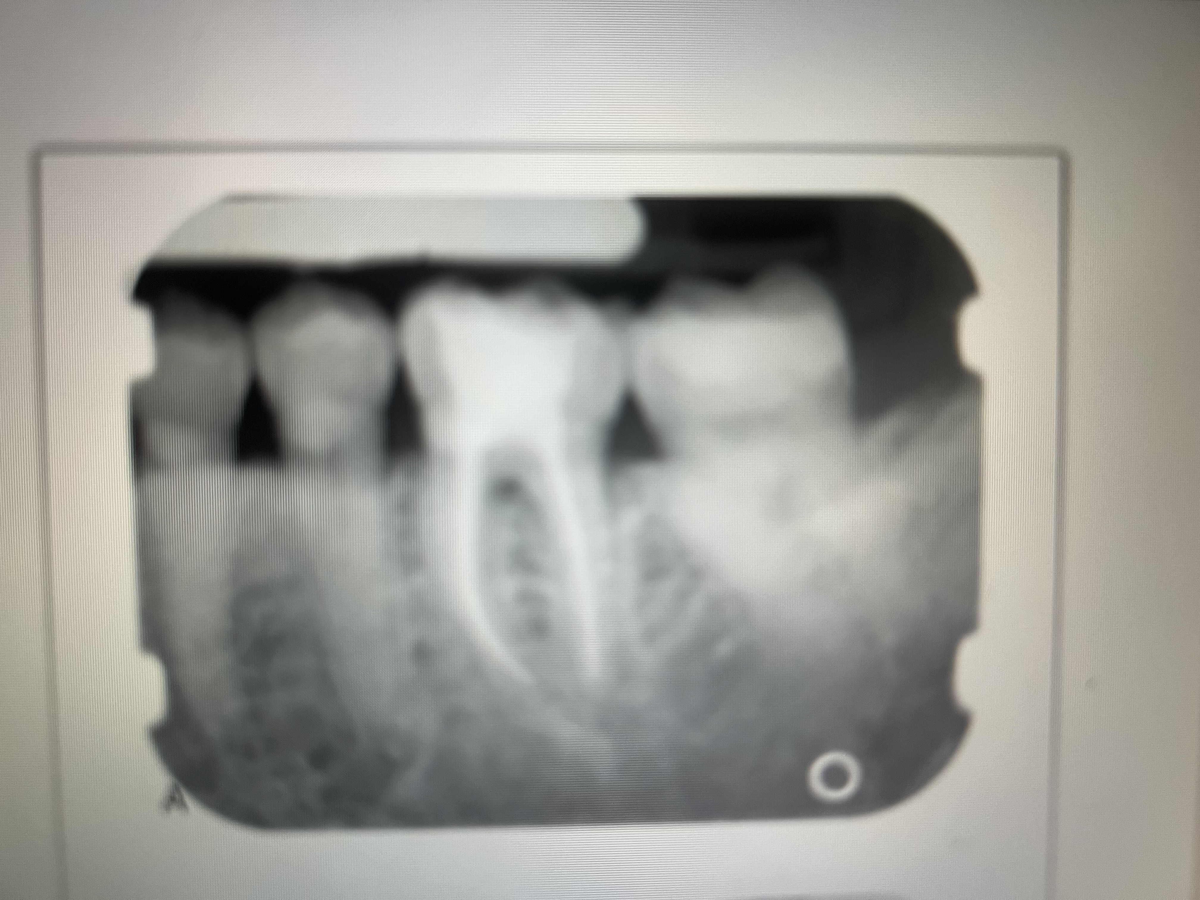 <p>Claylike material used in endo to fill the canals. Radiopaque. </p>