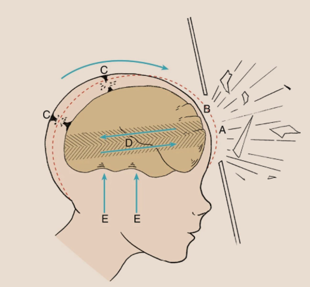 <p>Effect of brain movement which may tear small arteries and cause subdural hemorrhages (letter D in the image)</p>
