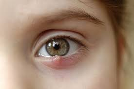 <p>PP: <strong>painful</strong>/tender/red infection of eyelid<br>inner margin of eyelid→obstructed meibomian gland<br>outer margin of eyelid→obstructed eyelash follicle/tear gland</p><p>E: s. aureus</p>