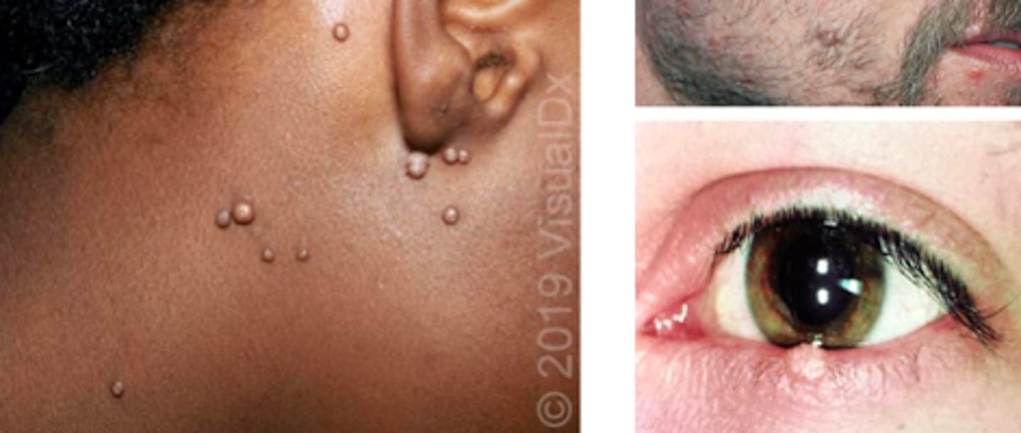 <p>Viral ID:</p><p>Subjective:</p><p>Skin-colored lesions (usually not red, but are usually shiny)</p><p>Pruritus can be present or absent</p><p>Generally painless unless irritated</p>