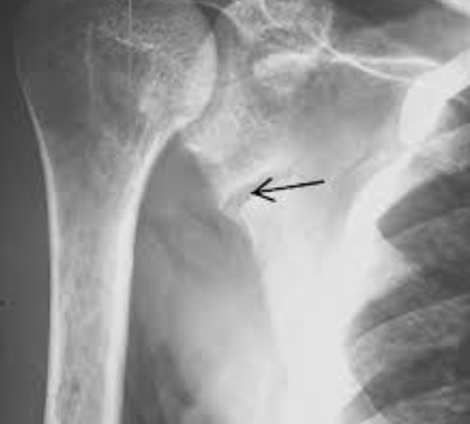 <p>What disease is this xray showing?</p>