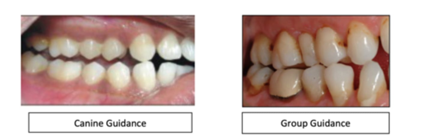 <p>two types</p><p>max and mand canines come into contact during lateral movements and therefore have laterotrusive contacts (between labial surfaces and incisal edges of the mand canines and the lingual fossa and incisal edges of the max canines</p><p>Canine guidance: only the canines come into contact during working movement</p><p>group guidance: canines and max and mand premolars and or molars contact</p>
