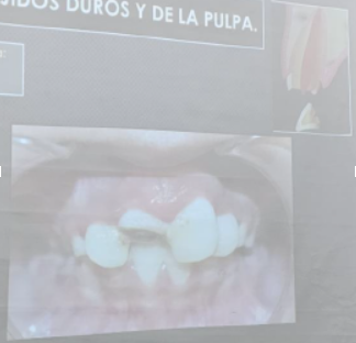 <ul><li><p><span>Vitalidad</span></p></li><li><p><span>Rx (fractura radicular)</span></p></li><li><p><span>Tx</span></p><ul><li><p><span>PJ. Mantener la vitalidad del tejido pulpar y promover la formación radicular</span></p></li></ul></li></ul><p></p>