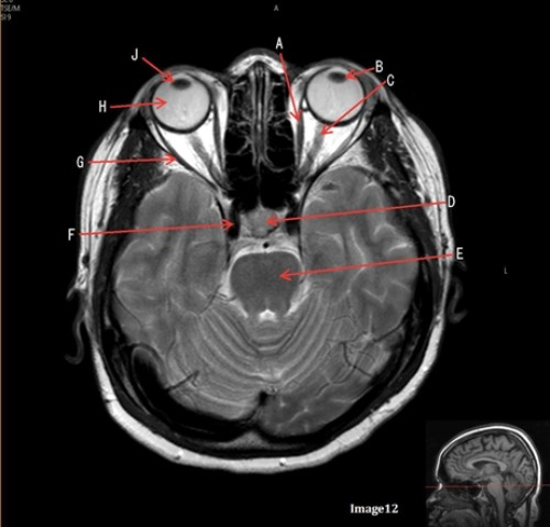 <p>Letter H in Image 12 is pointing to:</p><p>A. Lens</p><p>B. Lateral rectus muscle</p><p>C. Medial rectus muscle</p><p>D. Internal carotid artery</p><p>E. Globe</p>