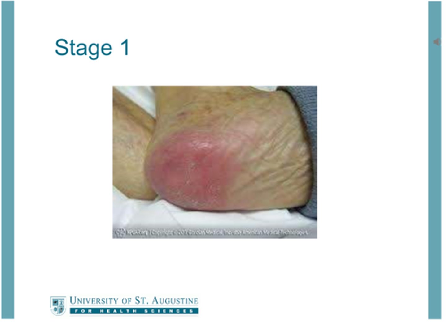 <p>-Nonblanchable erythema of intact skin</p><p>-Stays red when pressed down</p><p>-May appear differently on dark skin</p>