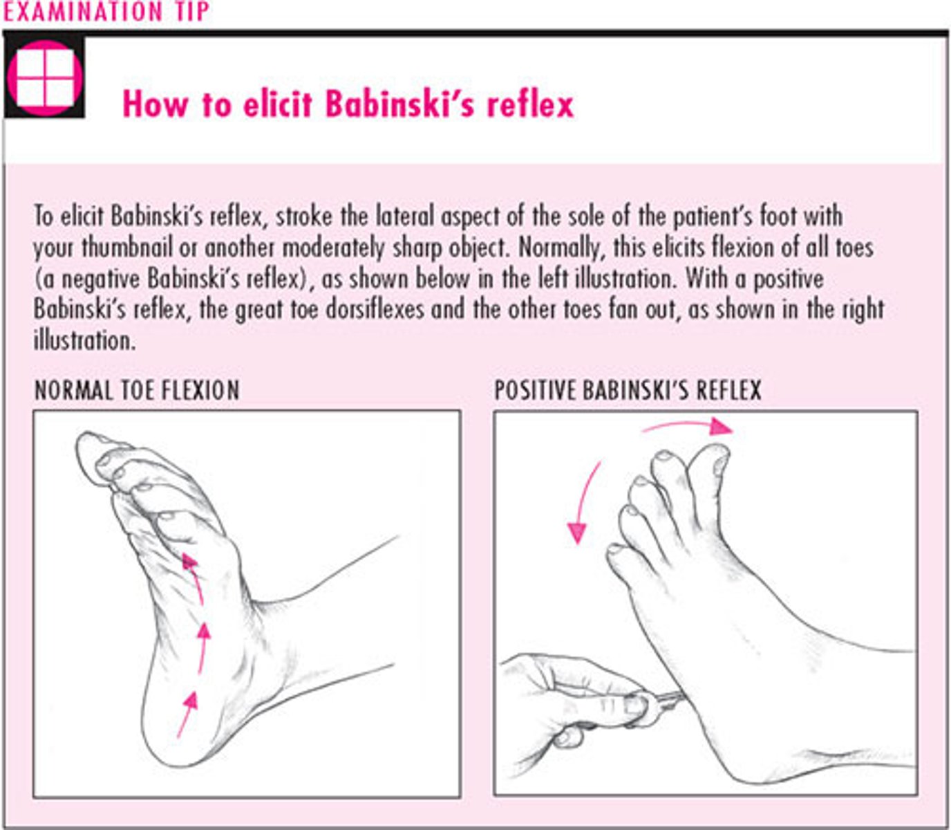 <p>abnormal plantar reflex test. Dorsiflexion of the big toe and fanning of the toes</p>