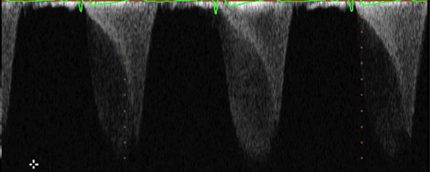 <p>A 45 year old patient comes to the lab as a referral from his doctor.&nbsp; He has had elevated blood pressure that has not responded to traditional medications.&nbsp; When performing his echo, you attempt to CW the MV to evaluate for any MR.&nbsp; You get the resulting waveform.&nbsp; What do we see here?</p>