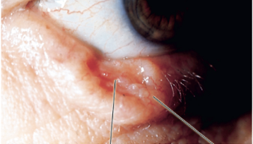 <p>Central ulceration with rolled edges. </p>
