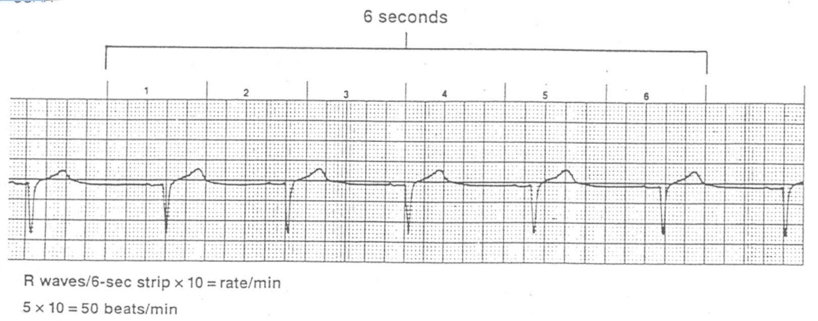 <ul><li><p>count number of complete QRS complexes within 6 second period and multiply by 10</p><ul><li><p>30 large boxes</p><ul><li><p>usually marked on strip chart</p><ul><li><p>we can assume all strips are 6 sec in length</p></li></ul></li></ul></li></ul></li><li><p>simplest, quickest, <strong>most common method</strong></p></li></ul><p></p>