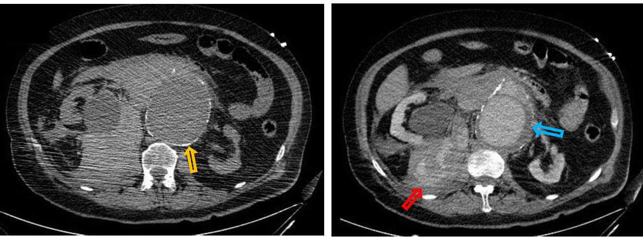 <p>Patient history: acute abdominal pain, hypotension, heart palpations and pulsatile abdominal mass in an elderly patient Modality: left: Non-enhanced CT, right: Postcontrast CT (venous phase), iv. iodine-based contrast agent </p><p>Region: abdomen, retroperitoneum </p><p>Radiologic sign: Dilated abdominal aortic aneurysm with wall calcifications (yellow arrow) and hypodense wall thrombus (blue arrow), retroperitoneal fluid collection with active extravasation of contrast material on postcontrast scan (fluid becomes denser, its average density is 60-80 HU, which is characteristic for fresh hematoma) (red arrow). The large hematoma pushes the right kidney ventrally.</p><p> Diagnosis: abdominal aortic aneurysm rupture</p>