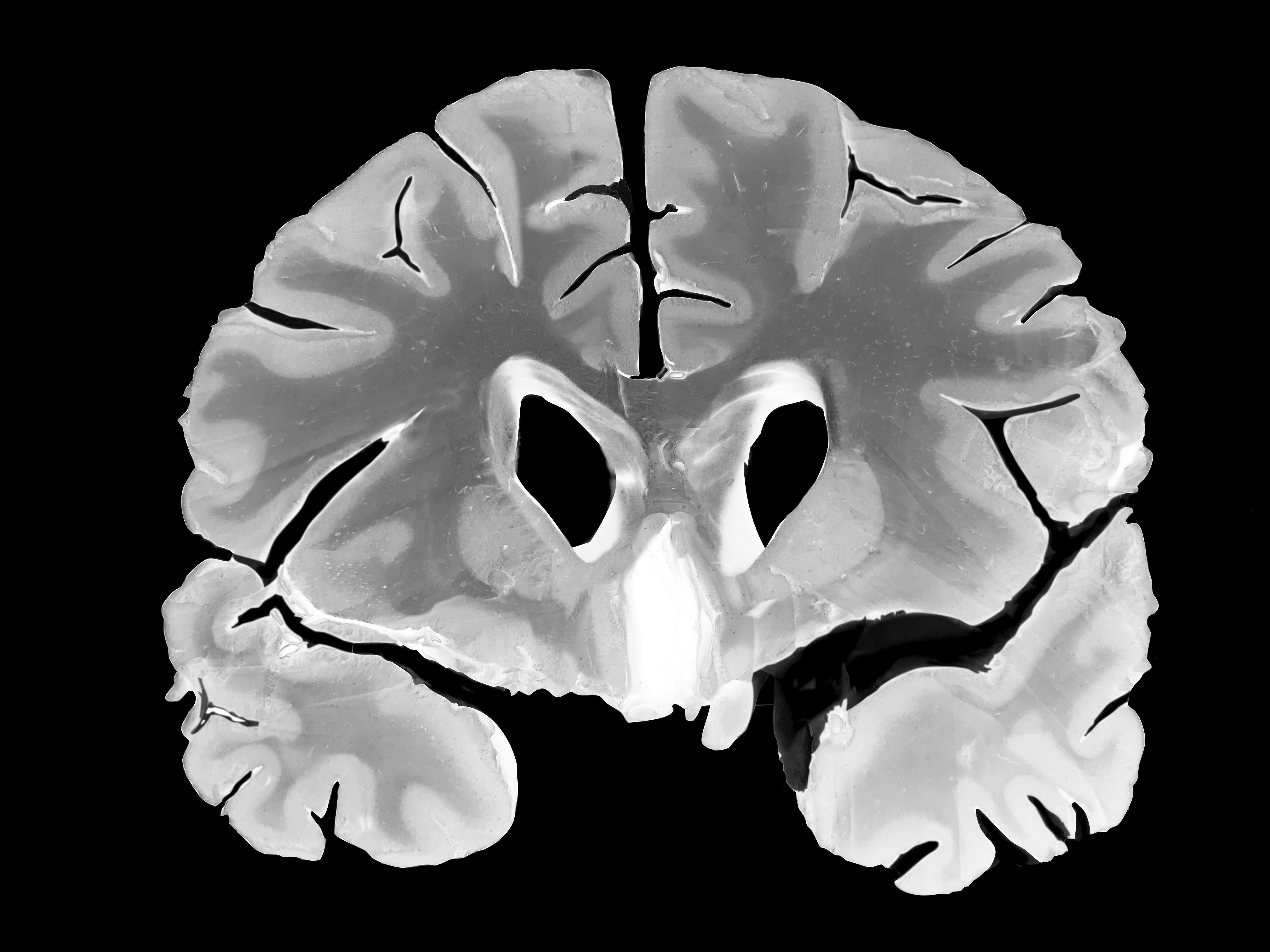 Chronic Traumatic Encephalopathy 