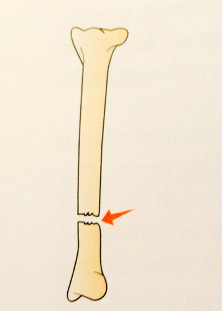 <p>complete fracture occurring straight across bone</p>