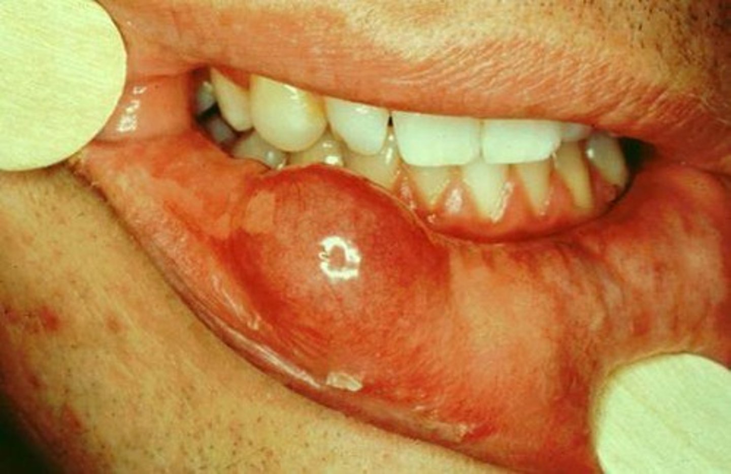 <p>Excise with salivary gland remnants</p><p>Mucocele- noncancerous cyst-like space in mouth that contains mucus (causes lip biting or trauma to face or mouth)</p>