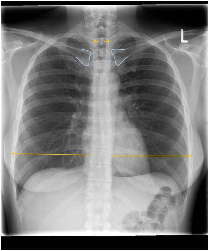 <p>Medial clavicles should be equidistant from the spine; spinous processes centered; trachea midline.</p>