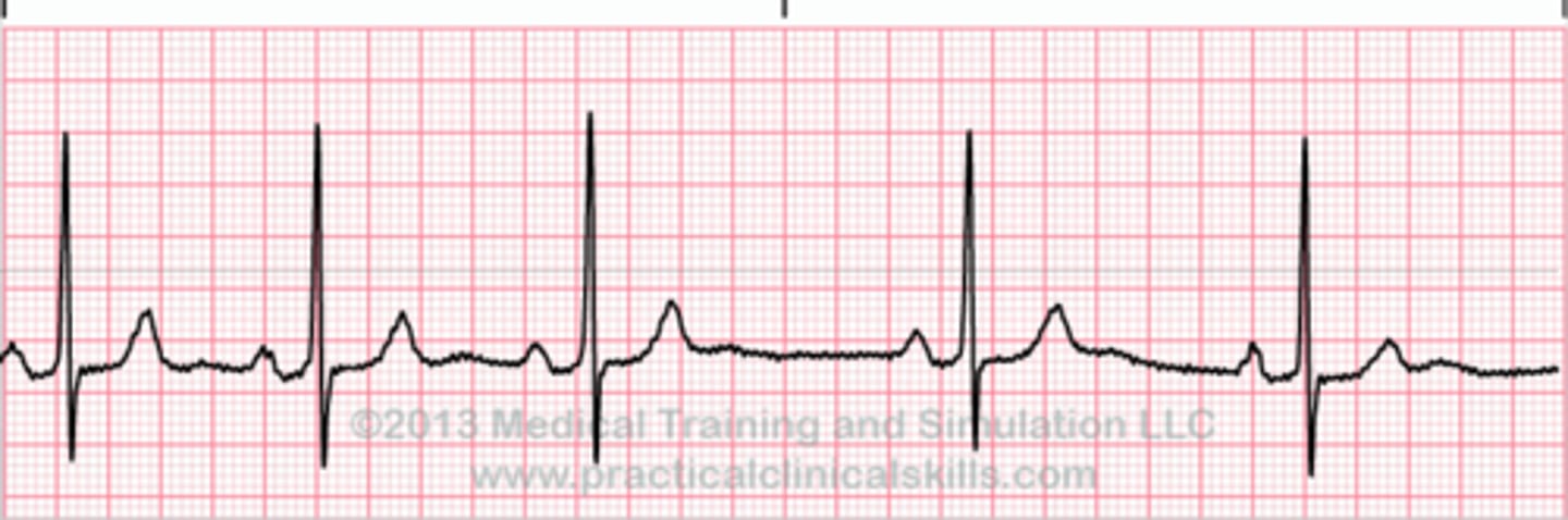 <p>Abnormal heart rhythm</p>