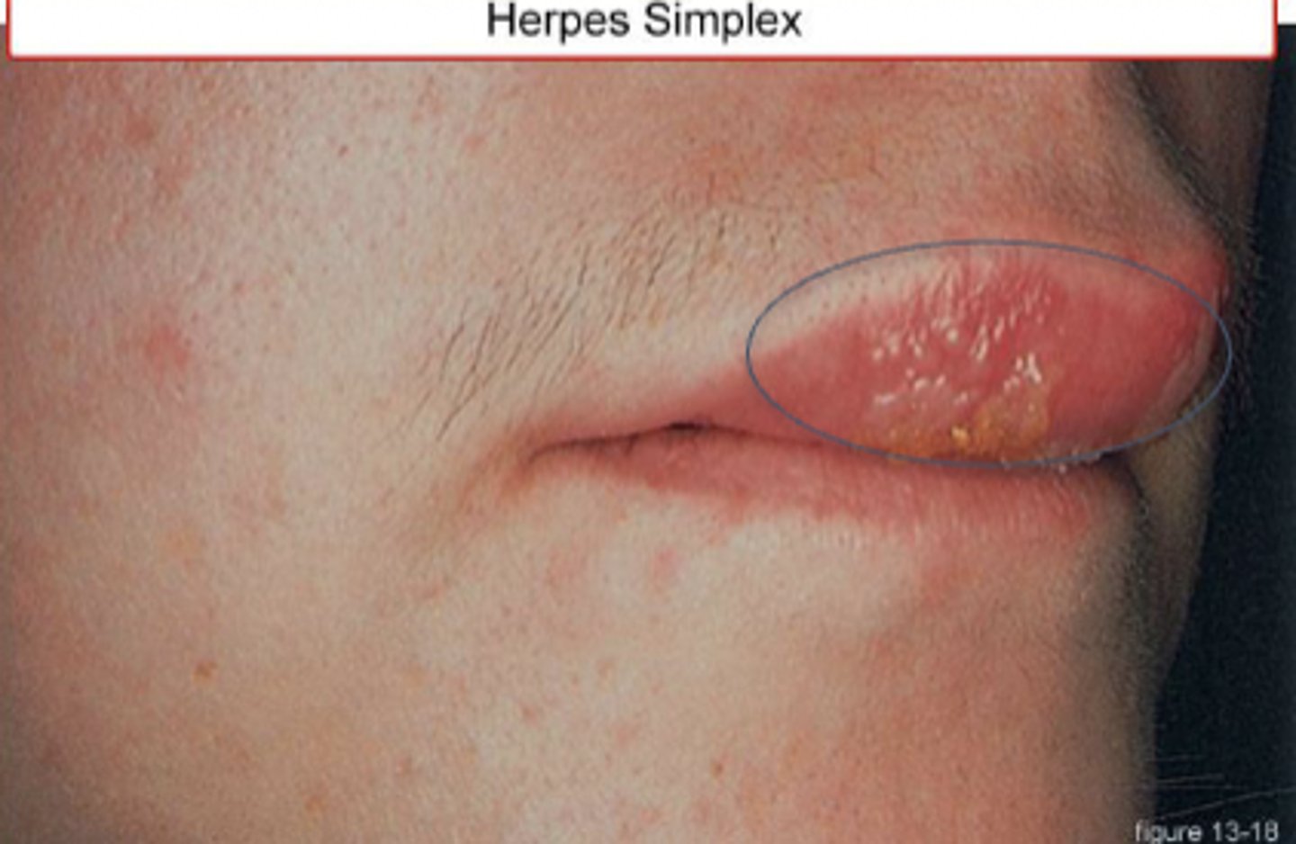 <p>< 5mm (blister)</p>