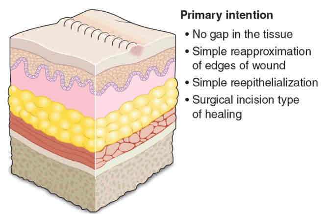 <p>Cleanly lacerated, clear wound edges, and easily brought together</p><ul><li><p>e.g., surgical incision</p></li></ul><p>Minimal scarring; easy healing</p><p>Simple epithelialization</p><ul><li><p>Within 5 days (granulation tissue)</p></li><li><p>Within 30 days (CT covered by an intact epidermis)</p></li></ul><p></p>