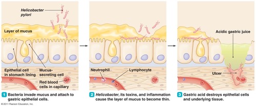 <p><strong>Stomach and duodenal ulcers</strong></p><p><strong>Acute gastritis</strong> (persistent or recurring pain in upper abdomen with no structural evidence for disease)</p>