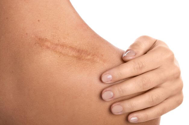 <p>Fibrous tissue replacing normal skin after injury or surgery </p>