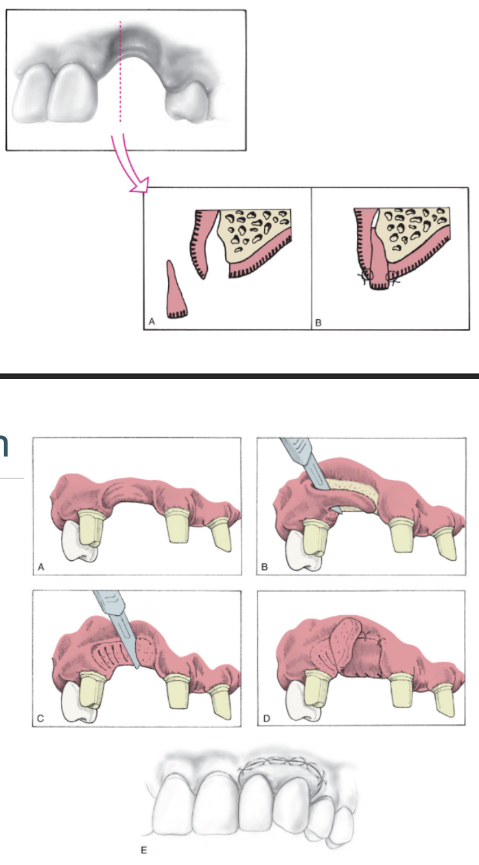 <ul><li><p>interpositional graft (top pic)</p></li><li><p>onlay graft (bottom pic)</p></li></ul><p></p>