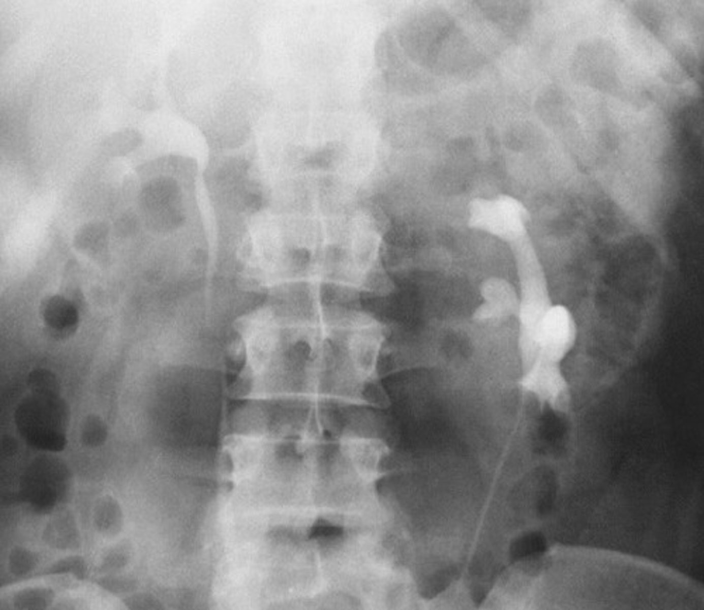 <p>- What congenital anomaly refers to the kidney being rotated?</p><p>- How does this pathology appear radiographically?</p>