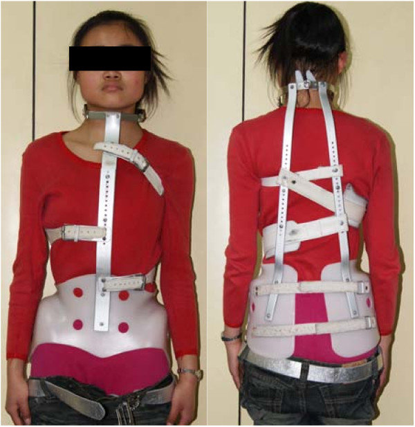 <p>-Worn for scoliosis, stabilizes the spine from the neck to the pelvis. The brace will often be worn at night several years after growth is complete to maintain the spinal correction.<br>-used for kids with kyphosis as well</p>