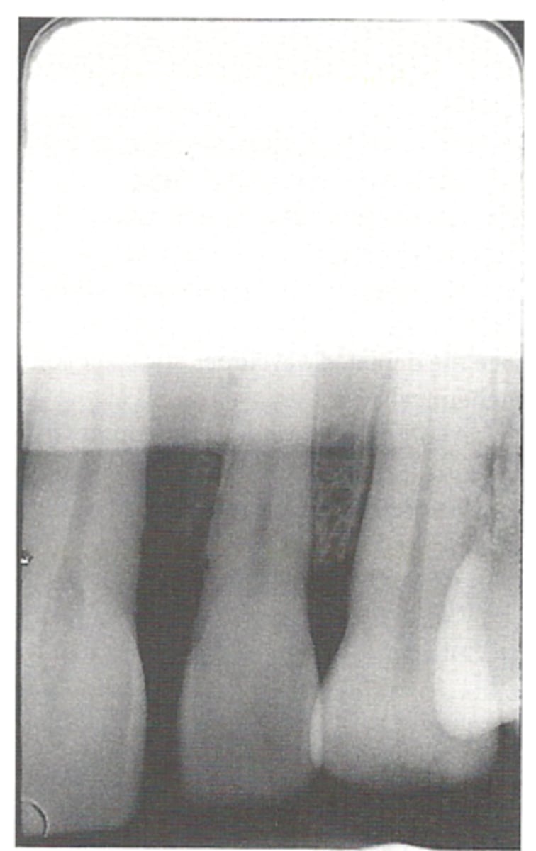 <p>straight white border caused by undeveloped part of film from low level of developer</p>