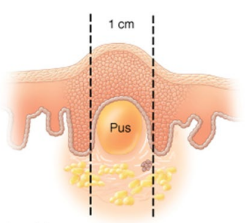 <p>What type of skin lesion is this?</p>
