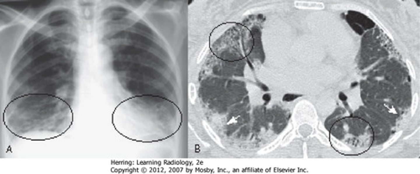 <p>A genetic disorder that affects the lungs and other organs, characterized by difficulty breathing, coughing up sputum, and lung infections.</p>
