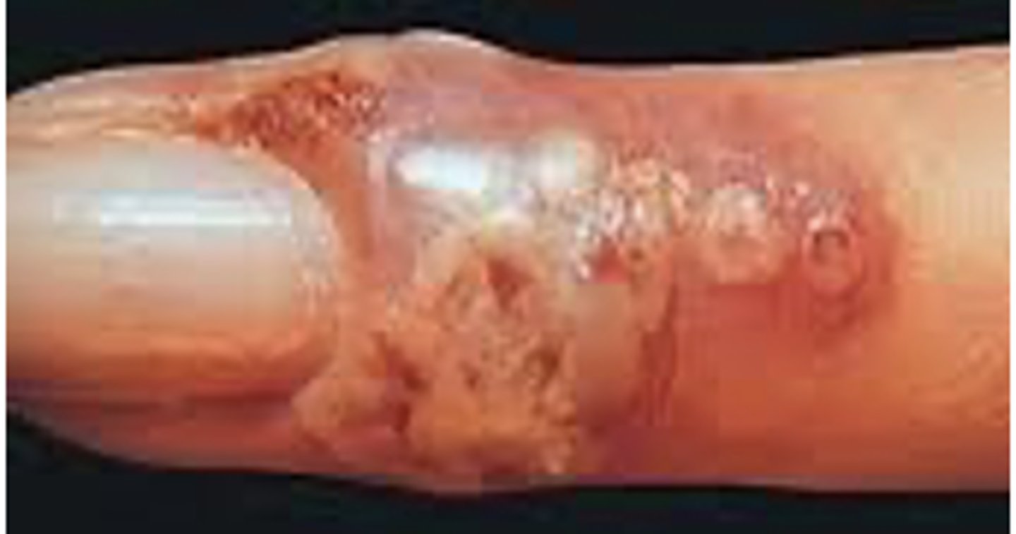 <p><strong>•Primary infection of fingers</strong></p><p>•Physicians, nurses, dental personnel</p><p><span style="text-decoration:underline">―Child sucking thumb</span></p>