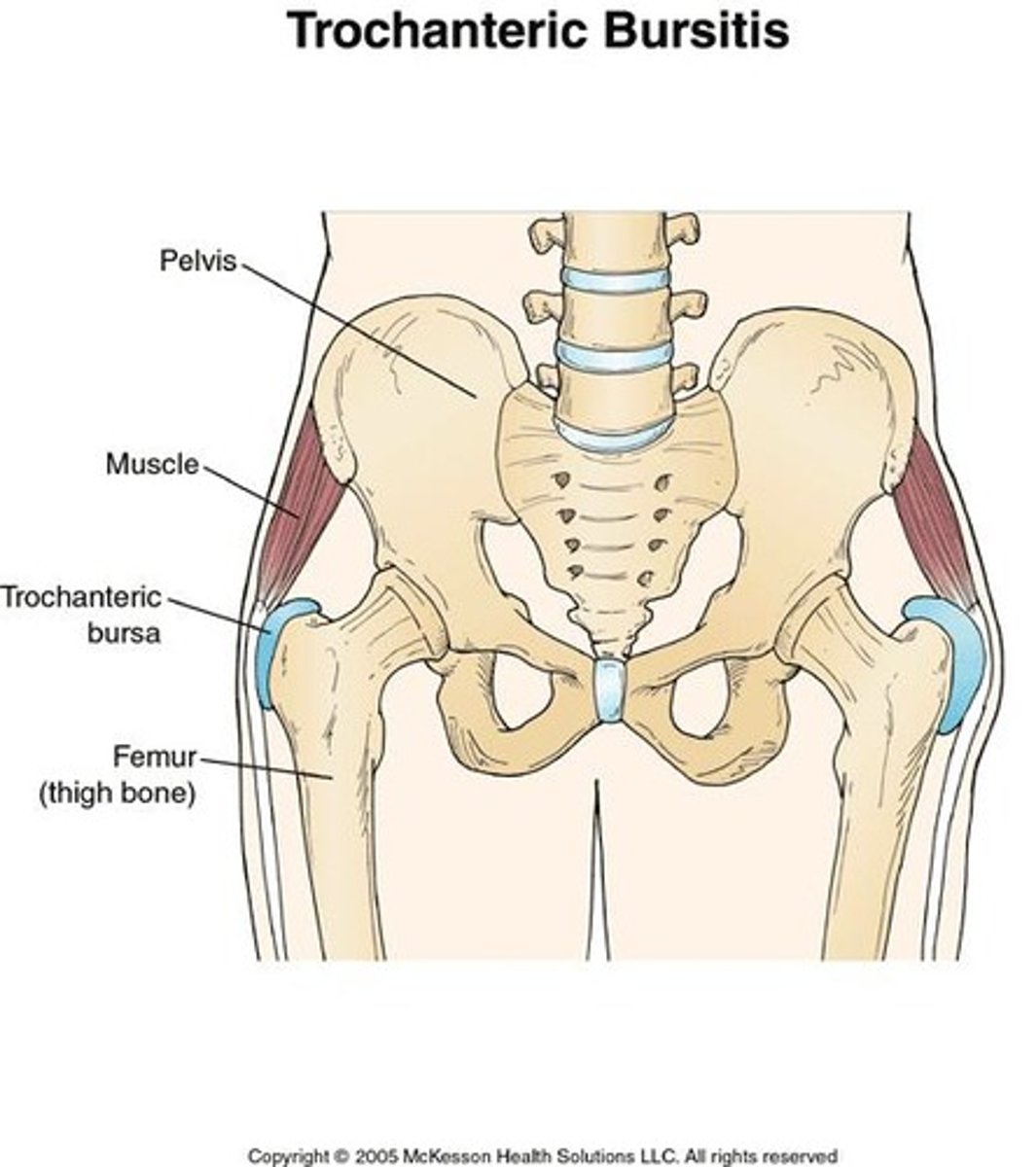 <p>Inflammation of bursae (fluid sacs around joints) results in ____ which is common in?</p>