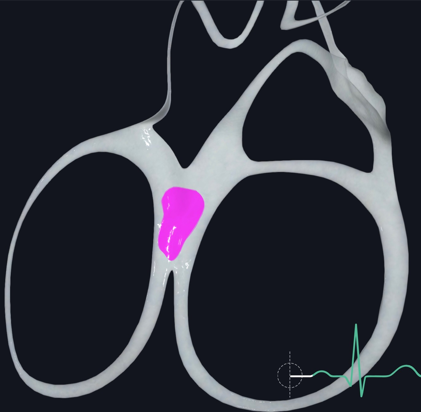 <p>1️⃣ Posterior horn<br />
2️⃣ Left anterior horn<br />
3️⃣ Right anterior horn</p>