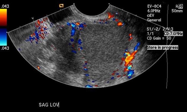 <ul><li><p>invades OUTSIDE THE UTERUS </p></li><li><p>15% are pre-meno</p></li><li><p><strong>chronic pelvic pain</strong></p></li><li><p><strong>DYSMENORRHEA = painful menses</strong></p></li><li><p>Infertility</p></li><li><p>painful sex</p></li><li><p>irregular bleeding</p></li><li><p>lower, abd pain</p></li></ul><p></p>