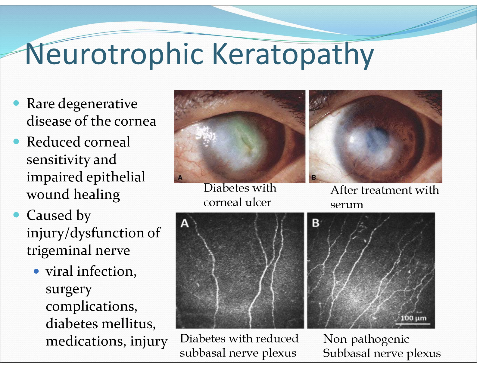 <p>A rare degenerative disease of the cornea due to reduced corneal sensitivity and impaired healing. It is caused by injury/dysfunction of the trigeminal nerve</p>