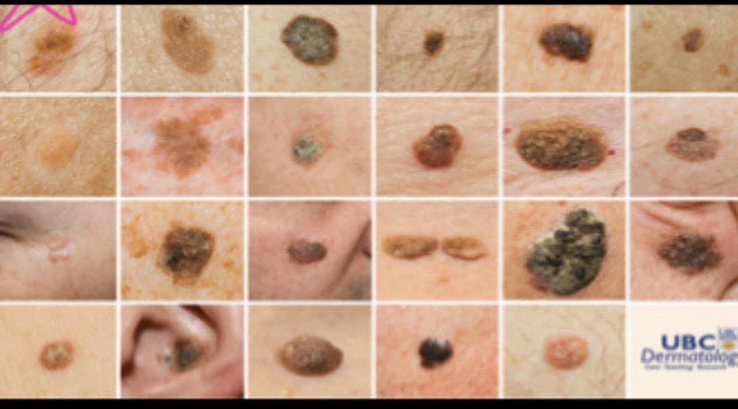 <p>Sebborhic Keratosis</p>