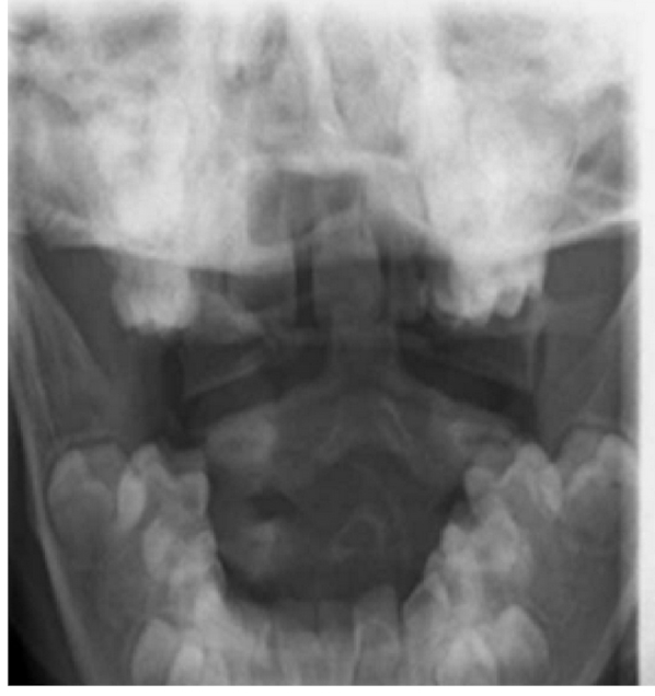 <ul><li><p>AKA: </p><ul><li><p>Ondontoid Fx</p></li></ul></li><li><p>20%</p></li><li><p>Neurological Involvement due to attachments of Alar and Transverse Ligs</p></li><li><p>MC C/S Fx for ≥ 65 </p></li><li><p>Minimal Trauma </p></li></ul><p></p>