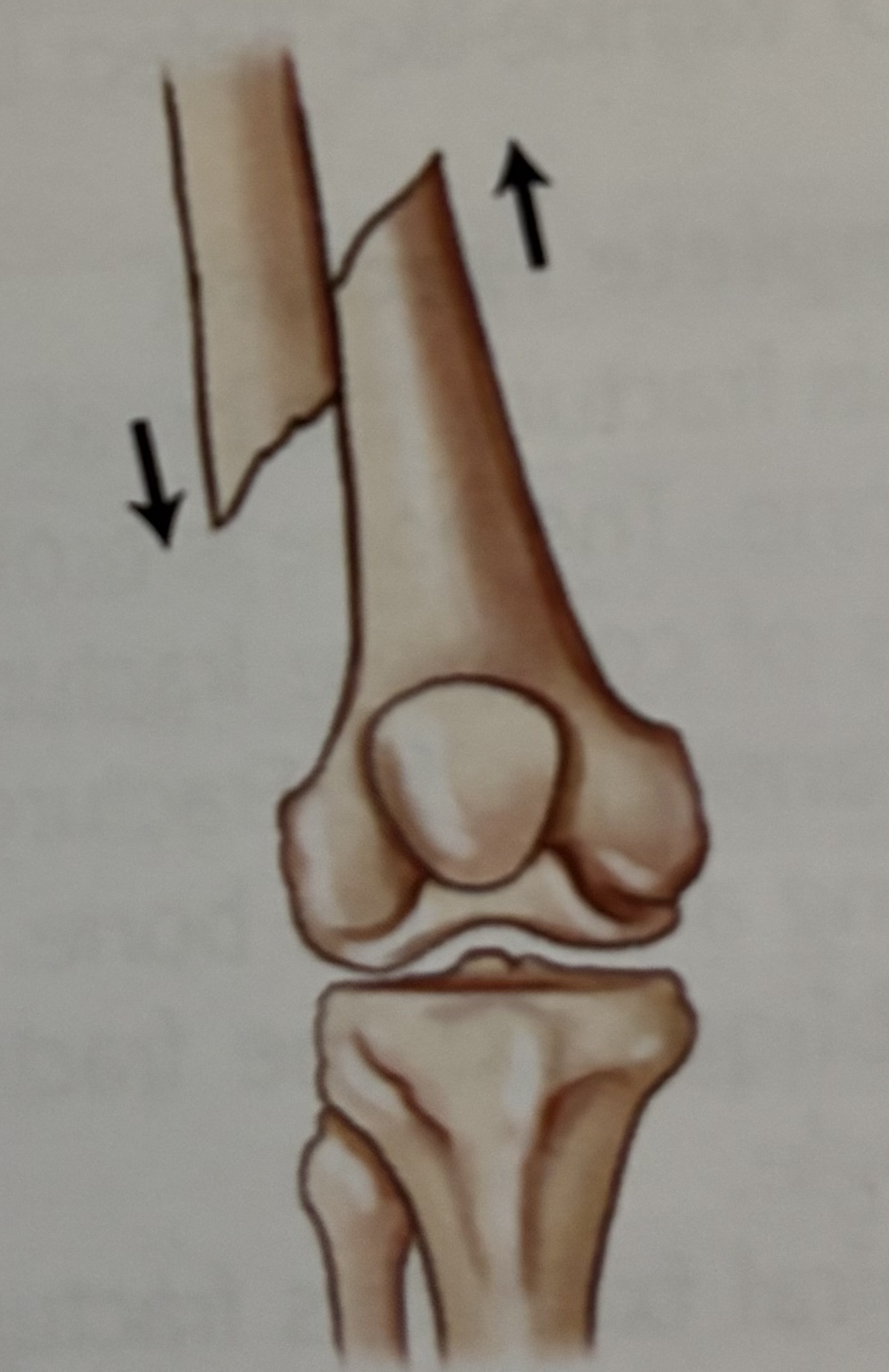 <p>What type of fracture is this?</p>