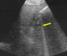 <ul><li><p>type of reverberation artifact</p></li><li><p>small focal reflectors cause a narrow reverberation artifact</p></li><li><p>useful in diagnosis of <span>adenomyomatosis/cholesterolosis of the GB and colloid thyroid nodules</span></p></li></ul>