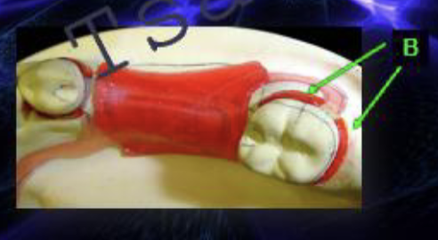 <p>what type of blockout is B</p>