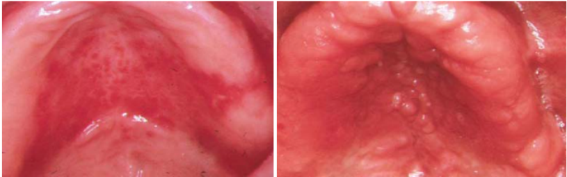<p>Name the candidiasis associated lesion</p>