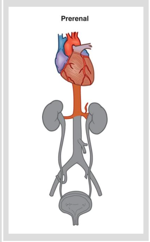 <p>Etio and Patho</p><p></p><p>Prerenal</p><ul><li><p>causes are factors that reduce systemic circulation, causing a reduction in renal blood flow</p><ul><li><p>severe dehydration, heart failure, decreased CO</p></li></ul></li><li><p>Decreases glomerular filtration rate</p><ul><li><p>causes oliguria</p></li></ul></li><li><p>Autoregulatory mechanisms attempt to preserve blood flow</p><ul><li><p>RAAS</p></li></ul></li></ul><p></p><p></p><p>Associated diseases</p><ul><li><p>addisons</p></li><li><p>CHF</p></li><li><p>hypovolemic shock —&gt; GI bleed</p></li></ul><p></p>