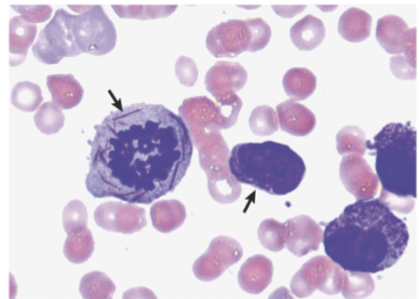 <p>Diagnostics for AML</p>