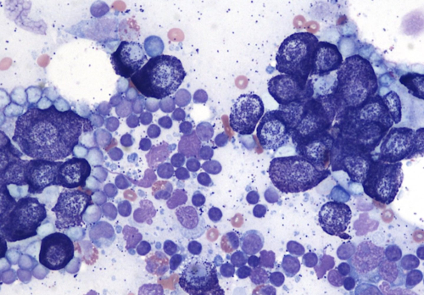 <p>What type of tumor is this?</p>