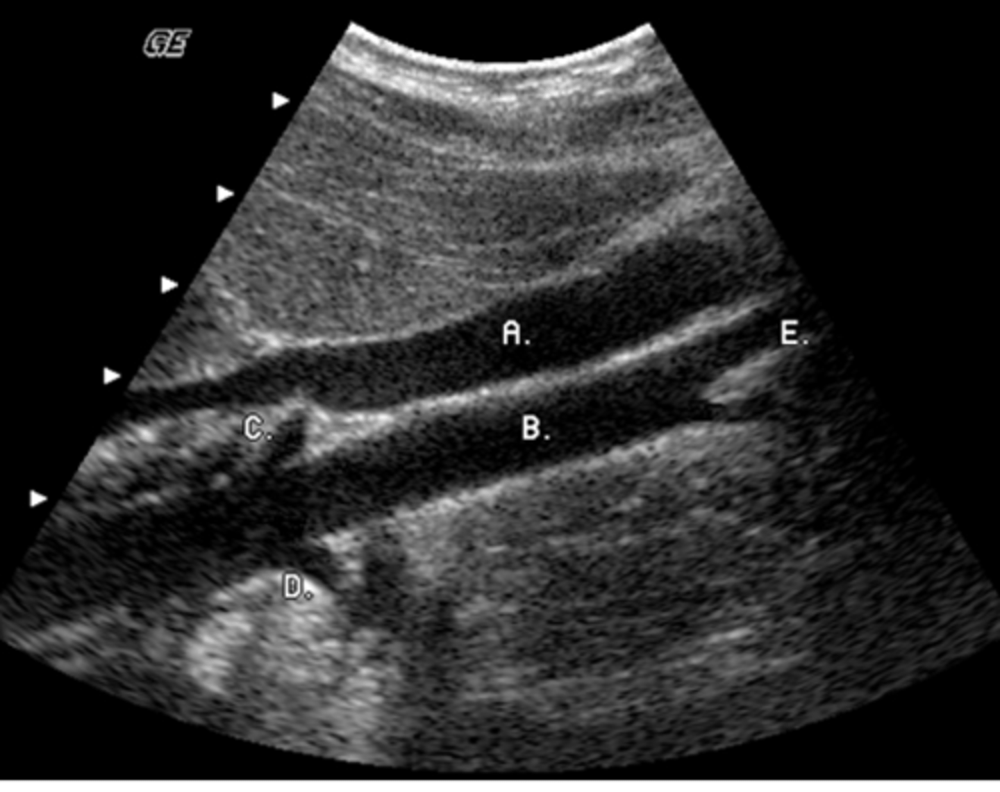 <p>This view is useful in the evaluation of what abnormality?</p><p>a. renal artery stenosis</p><p>b. multiple renal arteries</p><p>c. aortic aneurysm</p><p>d. IVC thrombosis</p><p>e. all of the above</p>