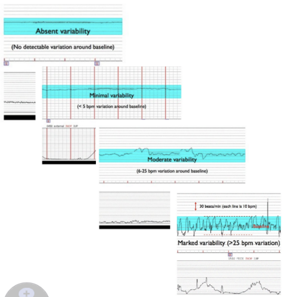 <p><mark data-color="red">absent: undetectable or 0 bpm</mark></p><p><mark data-color="yellow">minimal: 1-5 bpm</mark></p><p><mark data-color="green">moderate: 6-25 bpm</mark></p><p><mark data-color="red">marked: >25 bpm</mark></p>
