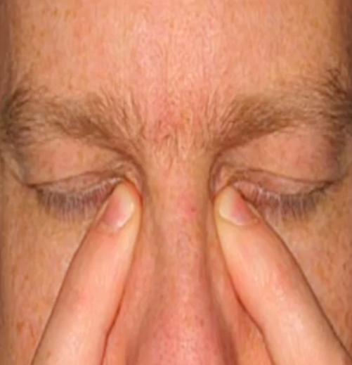 <p>betaxolol (Bet<strong>optic</strong> S) and timolol (Tim<strong>optic</strong>). for glaucomas</p><p>SE: blurred vision, photophobia (light sensitivity), dry eyes</p><p>AE: hypotension, bradycardia, bronchoconstriction (non-cardio)</p><p>use punctal occlusion (block puncta so drops in eye do not drain into nasal cavity for 30-60 seconds)</p>
