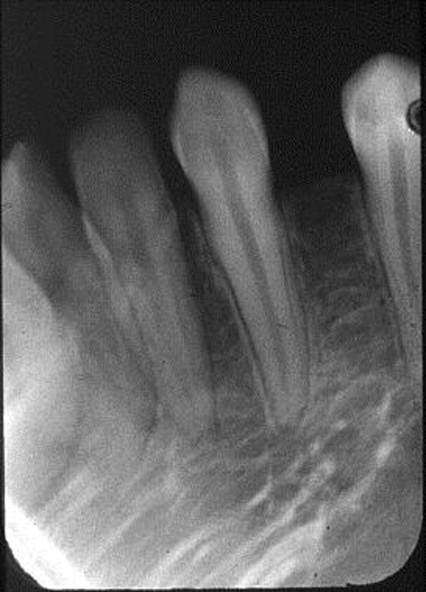 <p>Appearance-Images appear stretched and distorted</p><p>Cause-The plate was bent excessively</p><p>Correction-Check plate placement before exposure</p>