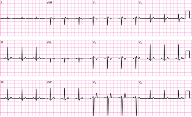 <p>leads represent different views of heart</p><p>limb leads: bipolar (I, II, III); unipolar (aVR, aVL, aVF)</p><p>chest leads: V1-V6</p><p>10 electrodes give 12 views</p>