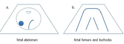 <p>Fetal presentation and position- left stomach towards right maternal side</p><p></p>